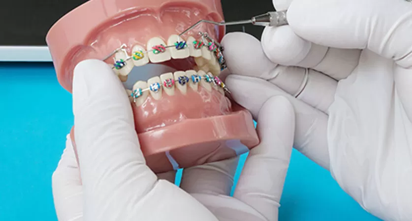 Procedure of Braces