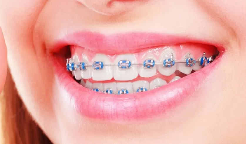 braces colors