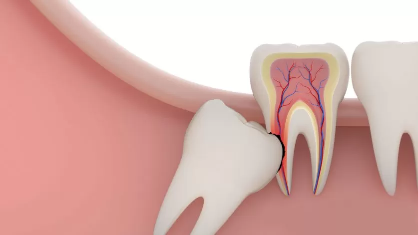 wisdom tooth extraction