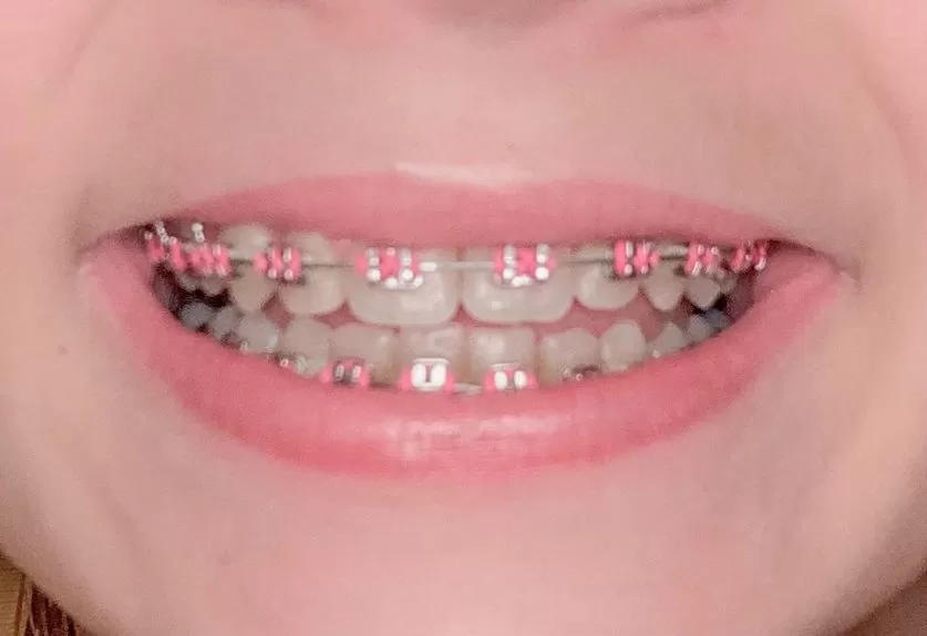 color braces