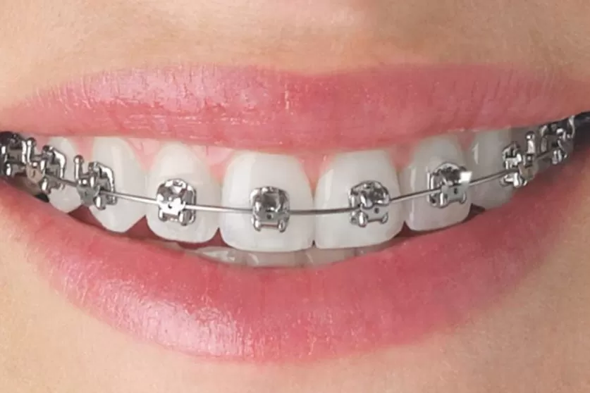 How long put braces