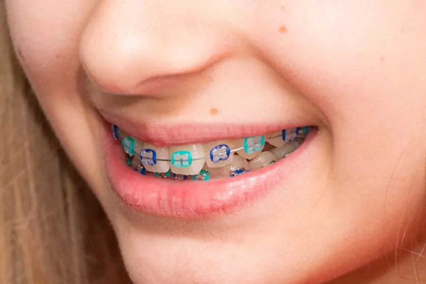 Kids Braces