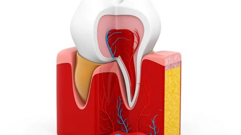 root canal