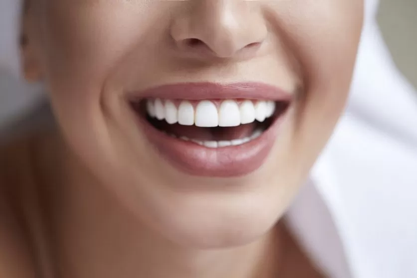 Veneers