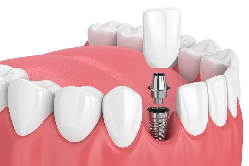 Dental Implants