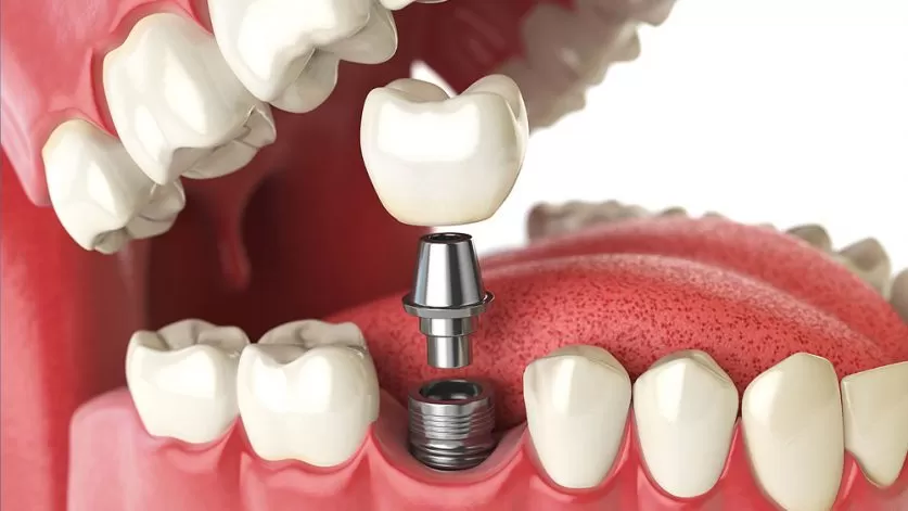 Dental Implants