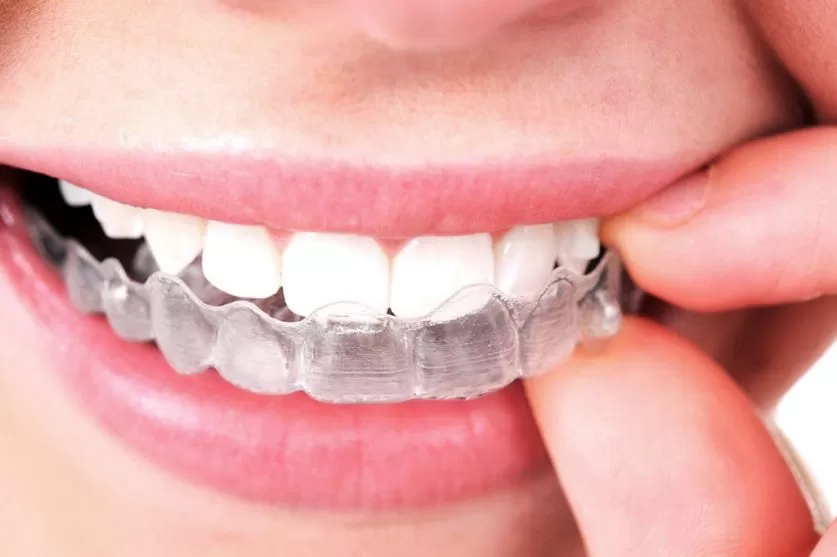 Invisalign