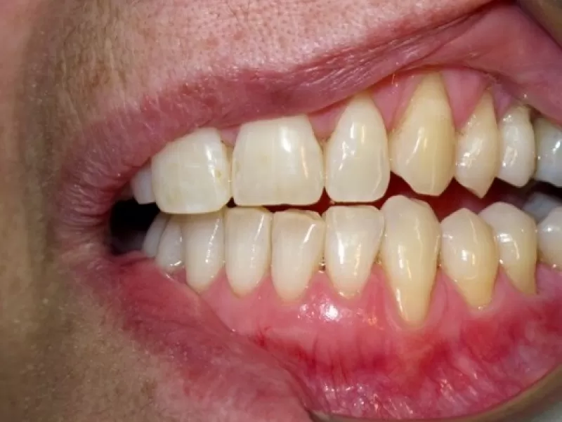 Gum Recession