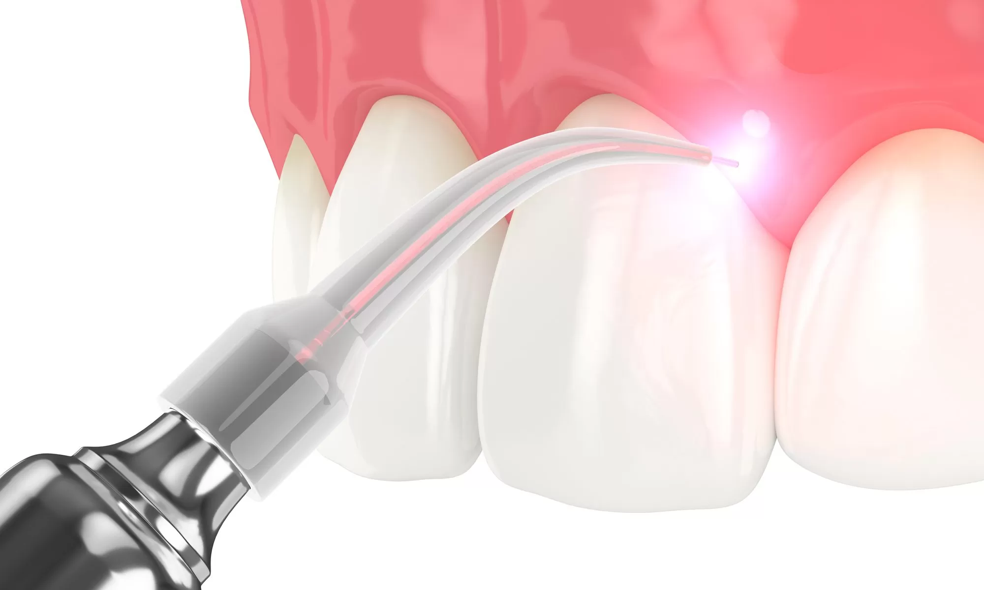 Laser Dentistry