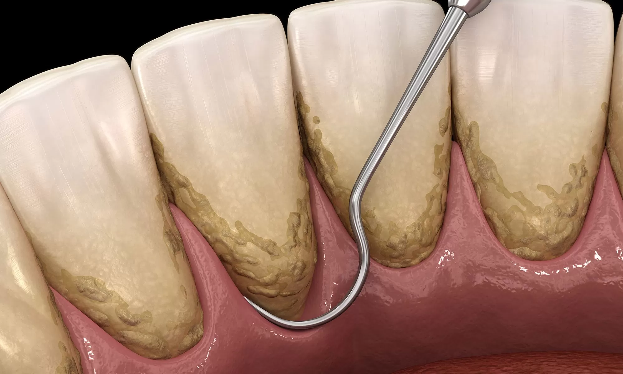 Deep Cleaning Teeth