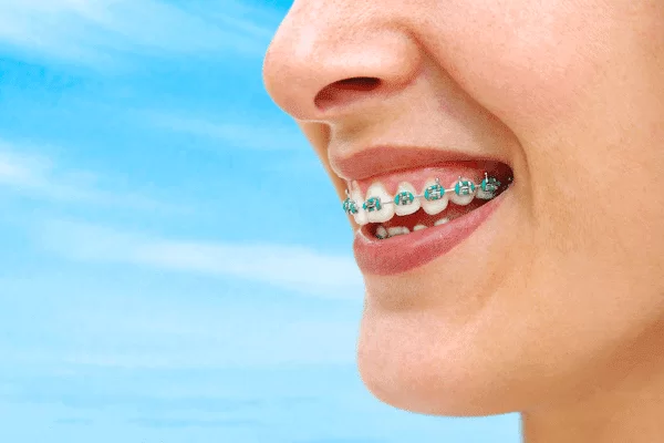 Dental Braces