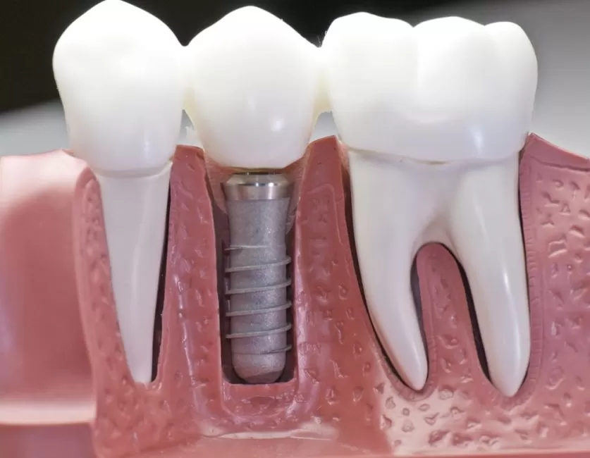 Dental Implant Surgery