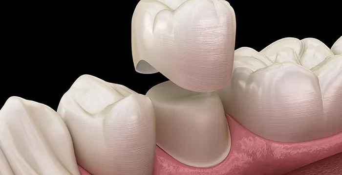 Dental Crowns