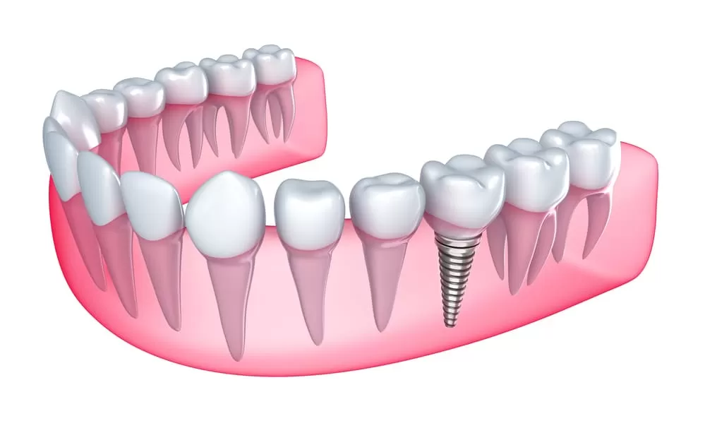 Dental Implants In Children